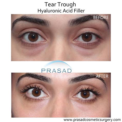 under eye filler omaha According to the American Society of Plastic Surgeons, the average cost of hyaluronic acid is $684 per syringe